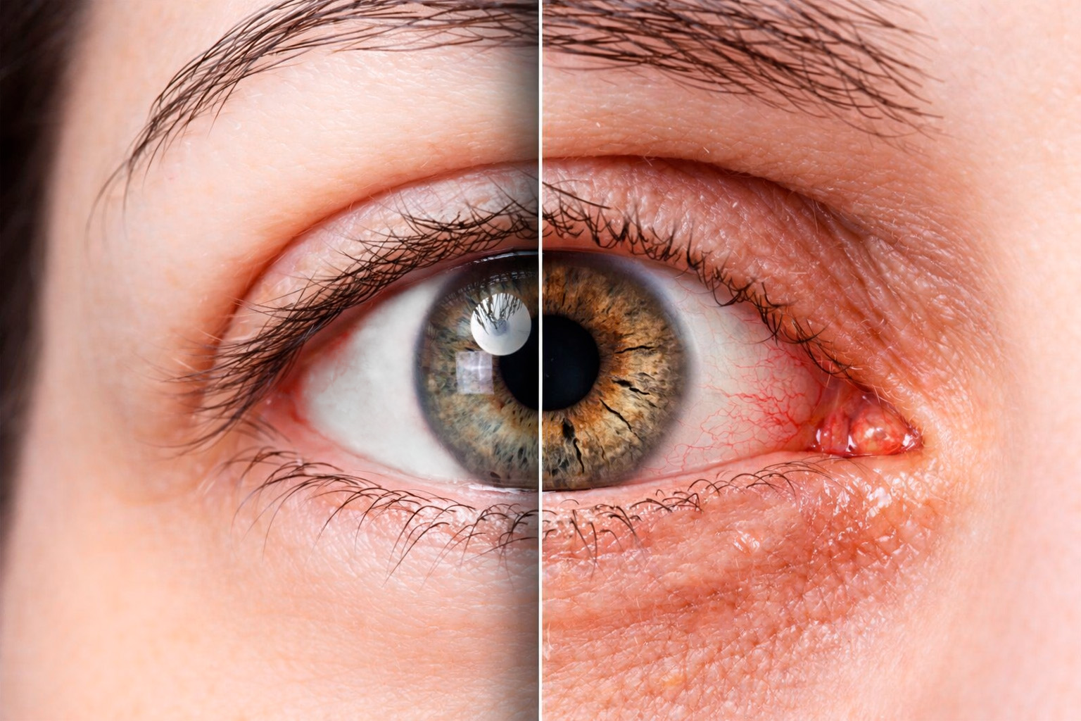 Sicca-Syndrom bei Lash-Stylistinnen: Ursachen, Symptome und Schutz während der Arbeit