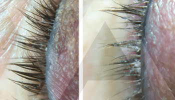 Демодекс на ресницах: как плохая гигиена влияет на здоровье глаз